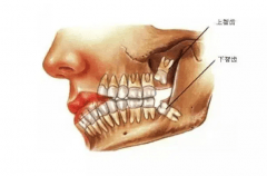 智齿是哪个牙齿：第三磨牙(大部分智齿需