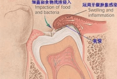 智齿从哪里长出来的：牙弓最靠里的位置